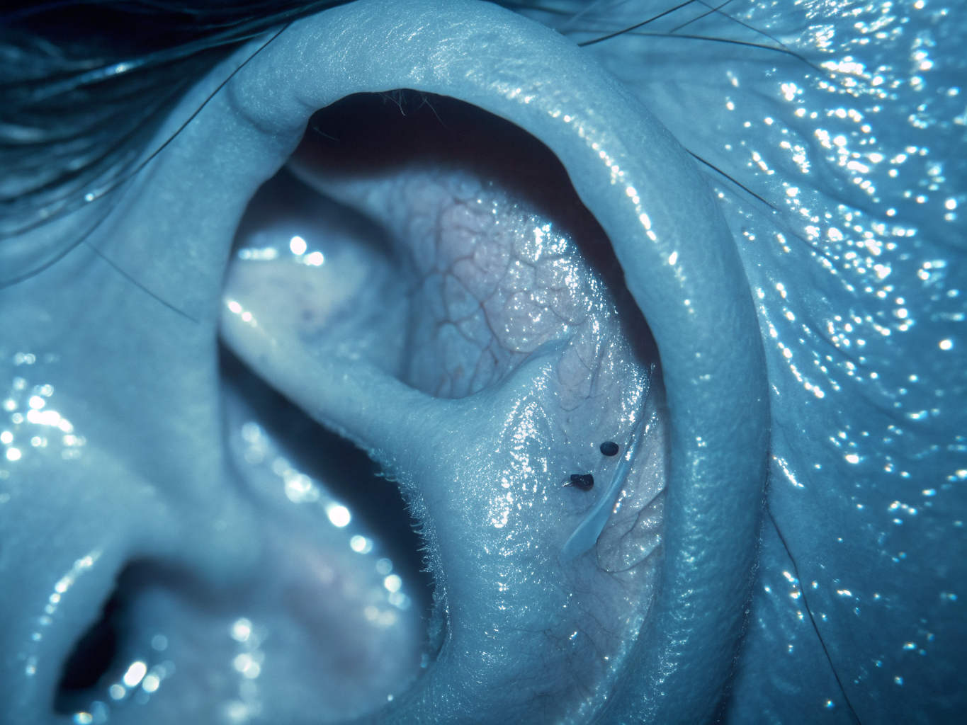 Anatomical diagram showing stapes fixation in otosclerosis